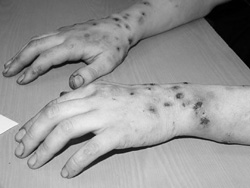 Начало процесса омертвения тканей: руки деморфинового наркомана