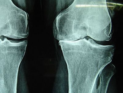 Девочку ждал год пребывания в гипсе...