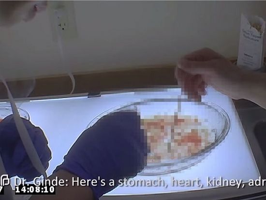 Фрагмент шокирующего видео. Доктор Гинд показывает на части абортированных младенцев: вот желудок, сердце, почки...